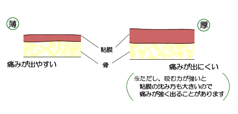 義歯治療