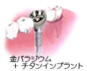 下の奥歯に1本埋入