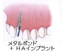 上の前歯に1本埋入