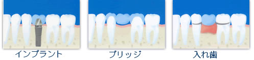 ブリッジや入れ歯との違い