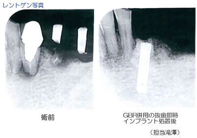 レントゲン写真