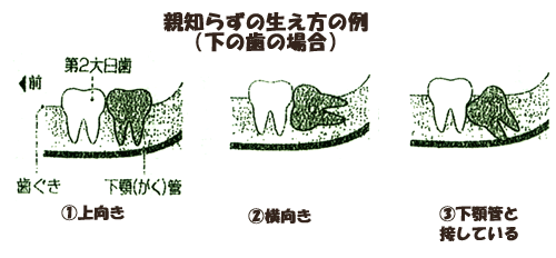 親知らずの抜歯が難しい理由