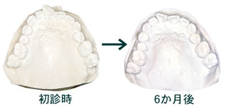 マウスピース矯正1