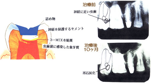 3mix法