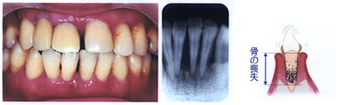 歯周炎3