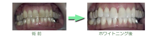 ホワイトニング　症例集